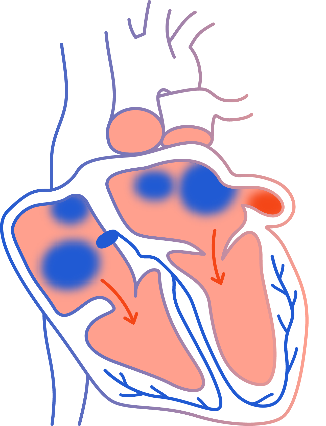 Unterschied_Vorhofflimmern_Kammerflimmern_smartcorLexikon
